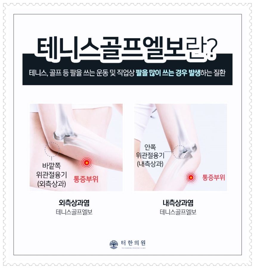 테니스골프엘보의 통증 부위를 설명한 그림