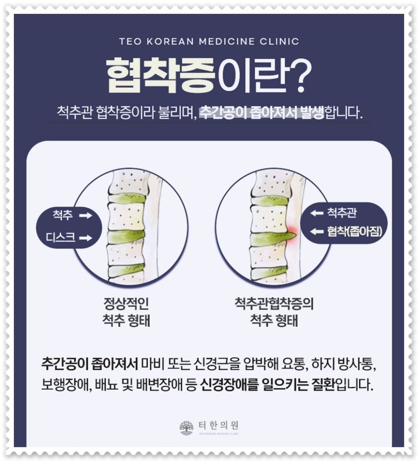정상 척추와 협착증 척추를 비교한 안내문