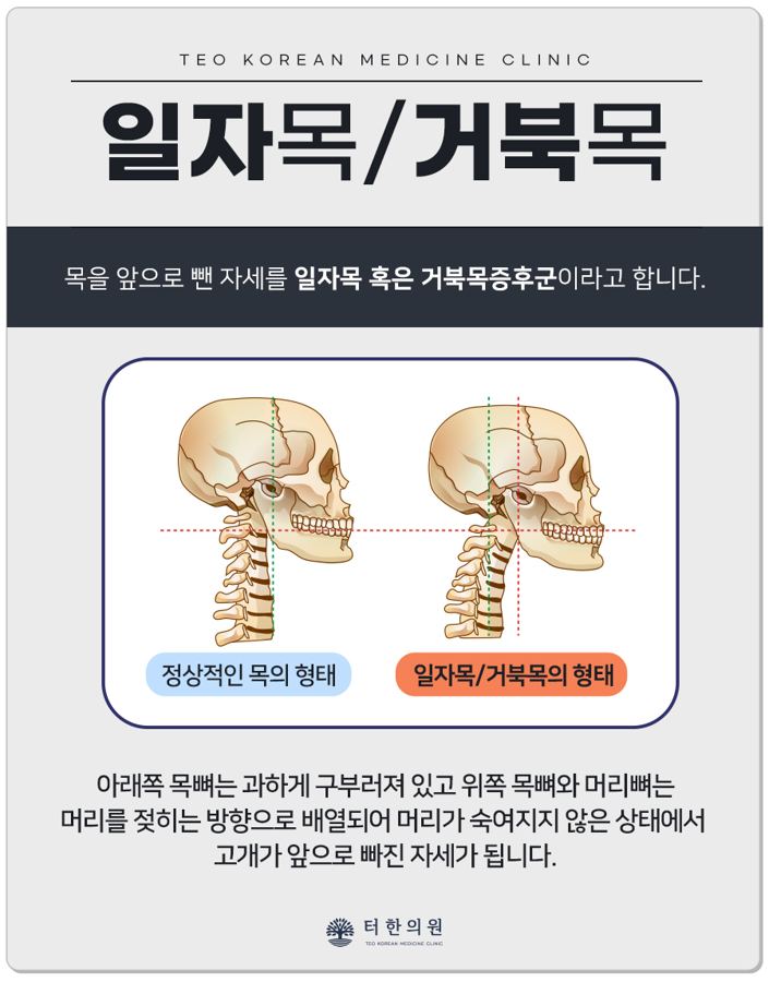 일자목과 거북목을 비교한 해부 그림