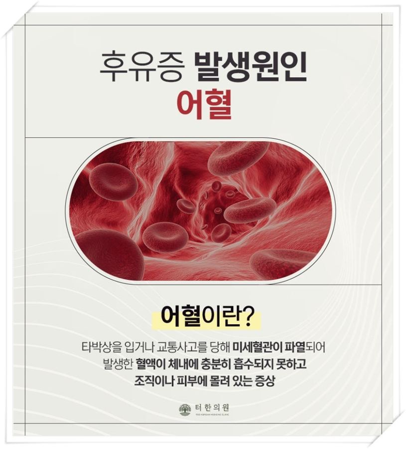 어혈의 의미와 생활 관리 방법을 설명한 안내문