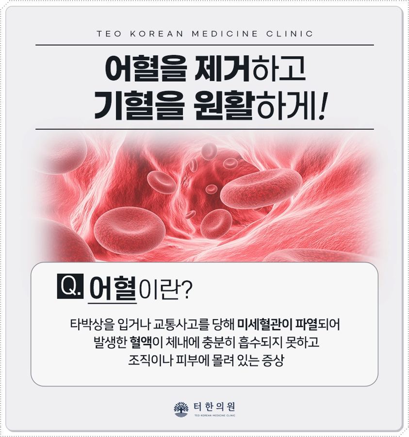 어혈을 설명한 적혈구 안내문