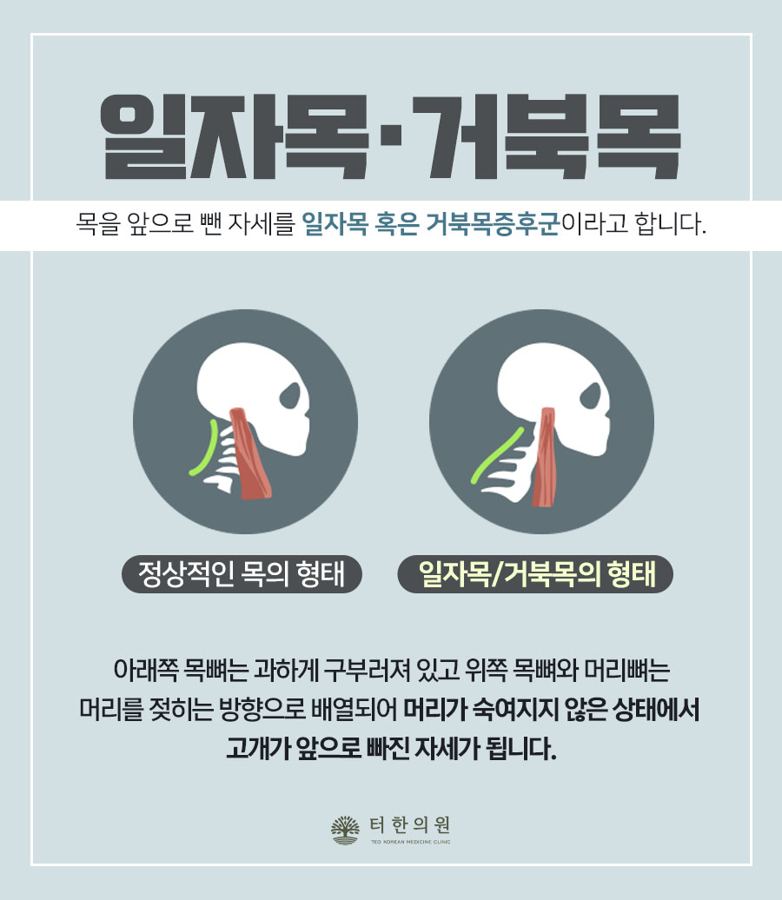일자목과 거북목 자세를 비교한 안내문