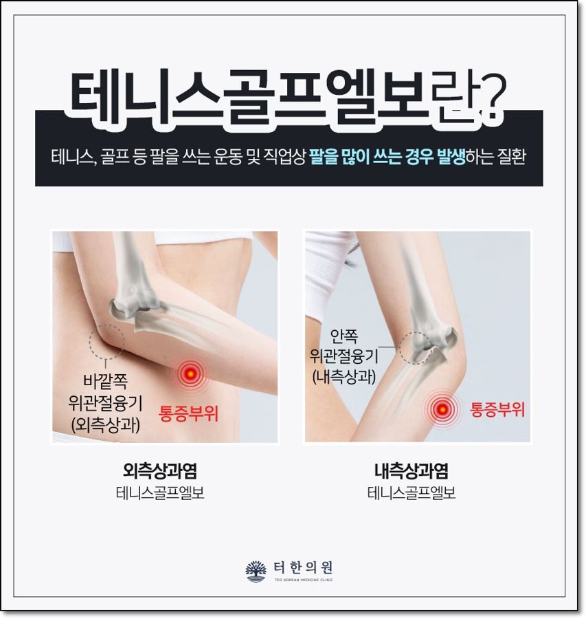테니스골프엘보 통증 부위를 설명한 안내문