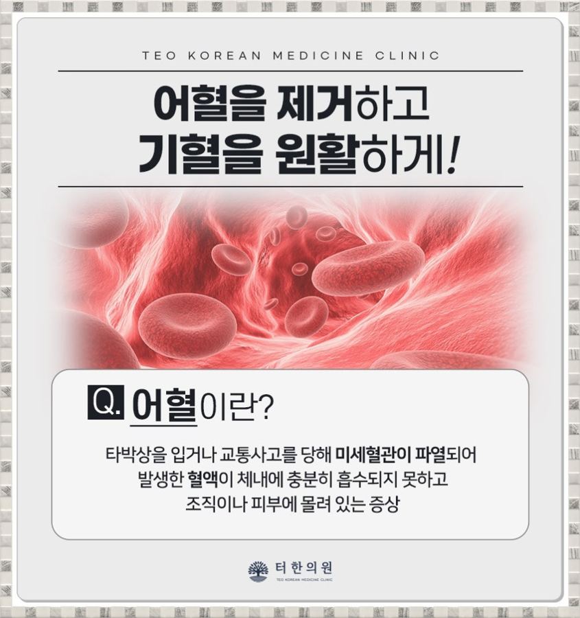 어혈의 의미와 생활 관리 방법을 설명한 안내문