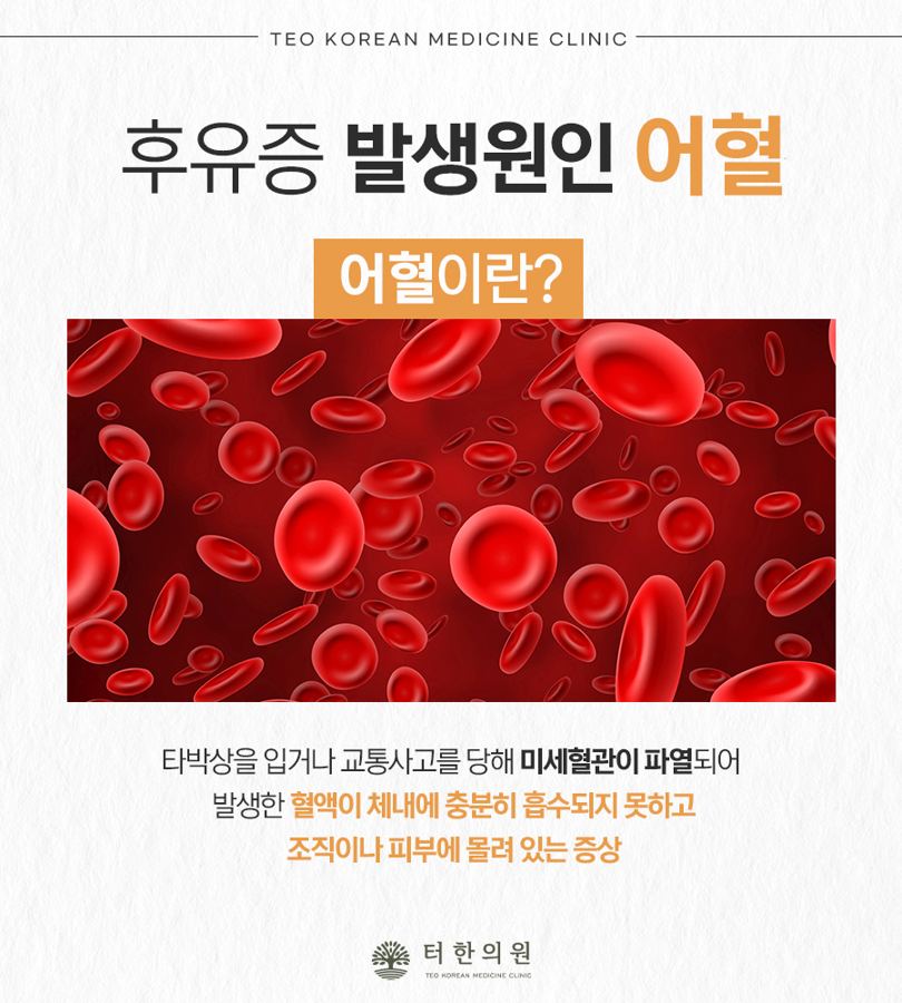 어혈을 설명한 적혈구 안내문