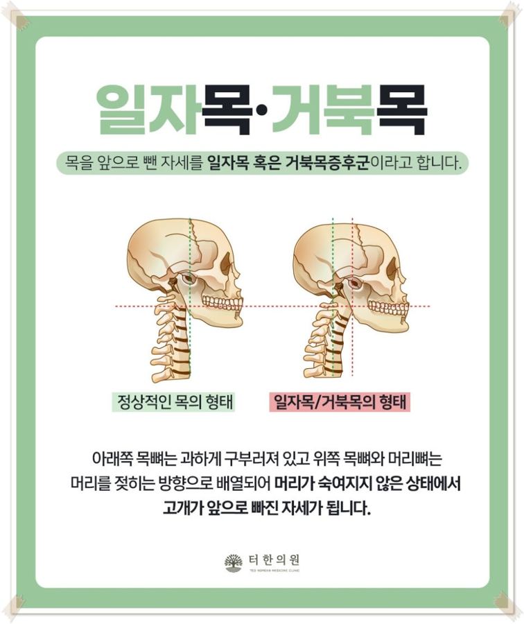 일자목과 거북목을 비교한 해부 그림
