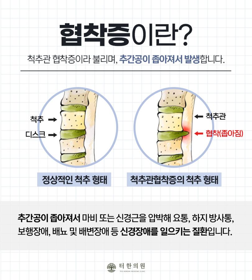 정상 척추와 협착증 척추를 비교한 그림