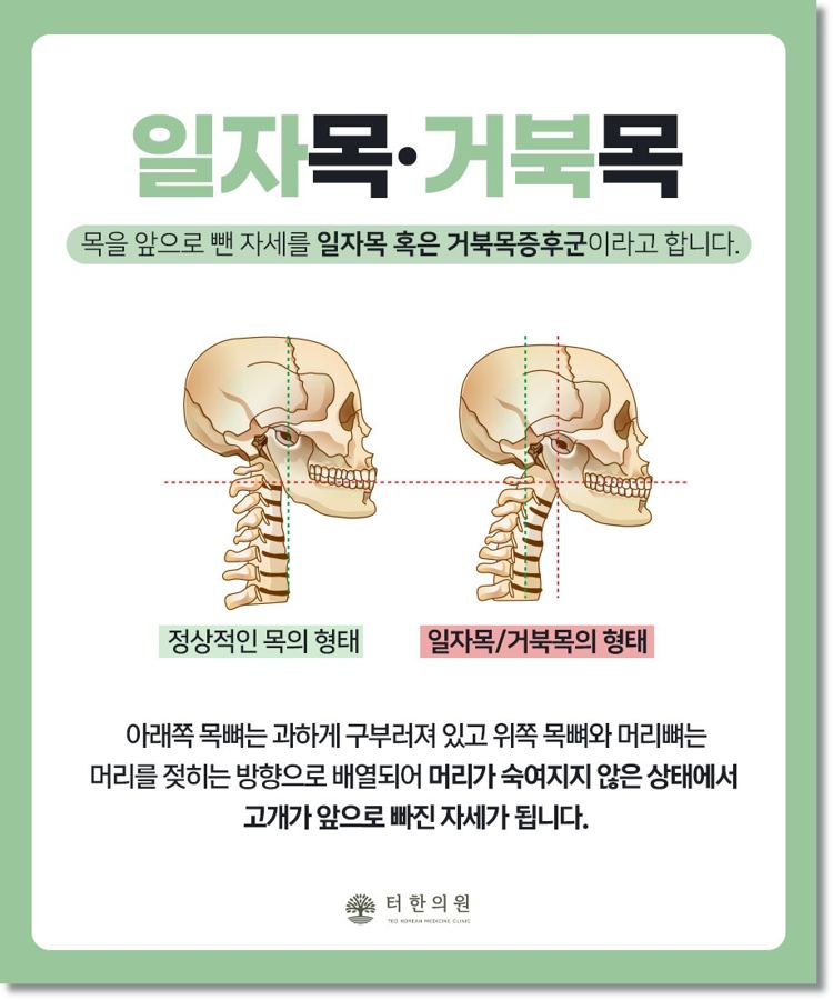 일자목과 거북목 자세를 비교한 해부 그림