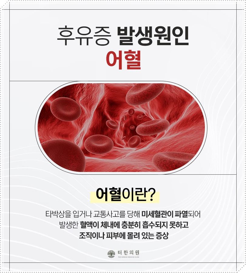 후유증 발생원인 어혈을 설명하는 카드뉴스