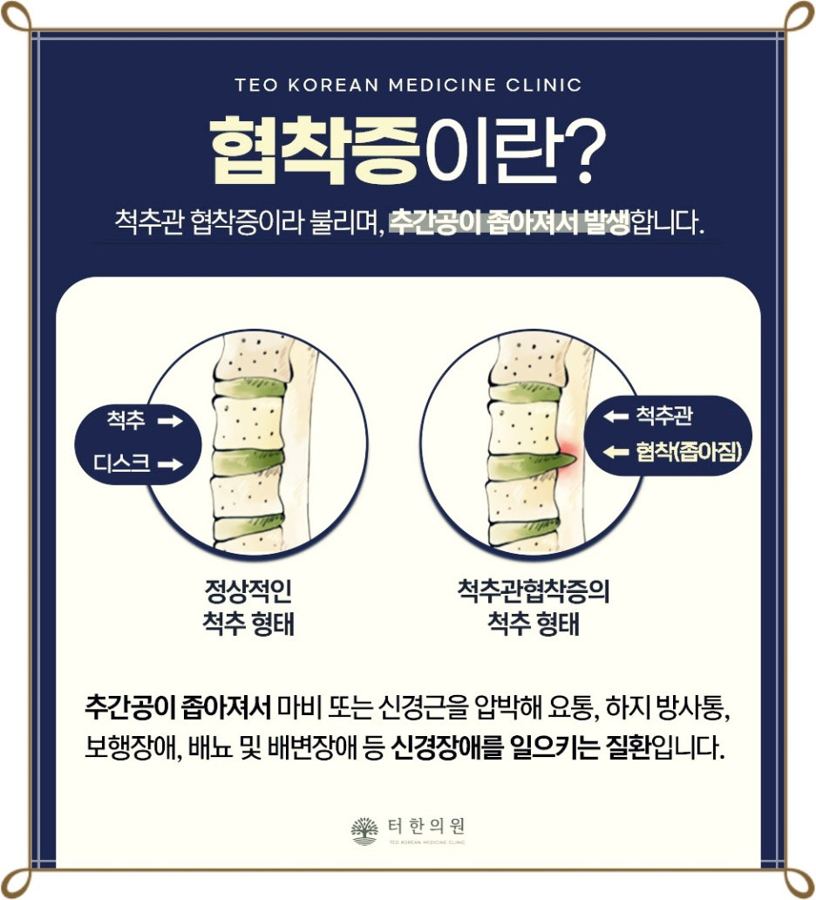 정상 척추와 척추관협착증 척추의 차이를 설명한 그림