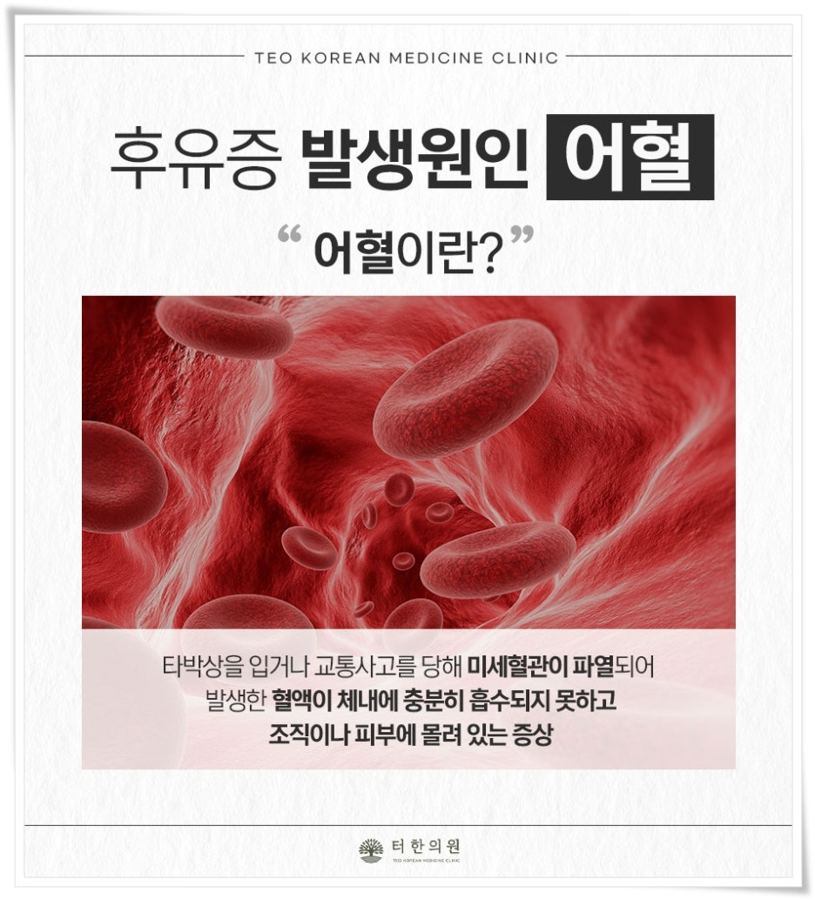 혈관 속 적혈구 그림으로 교통사고 후유증의 어혈을 설명한 이미지