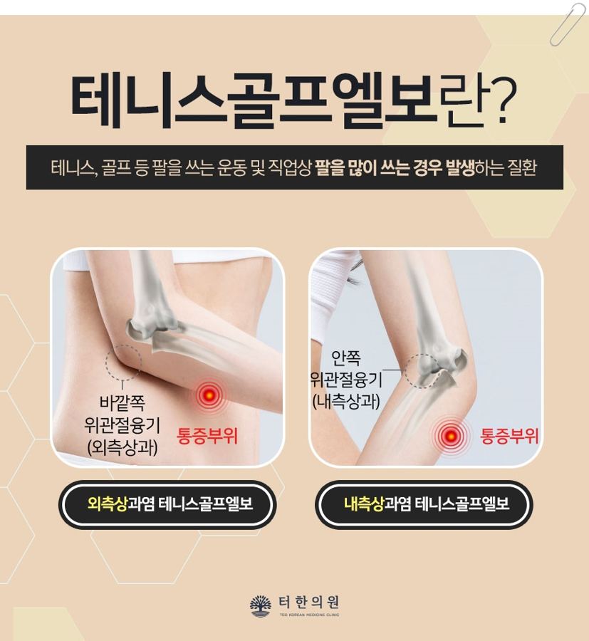 팔꿈치 바깥쪽과 안쪽 통증 부위를 표시한 테니스·골프엘보 안내 이미지