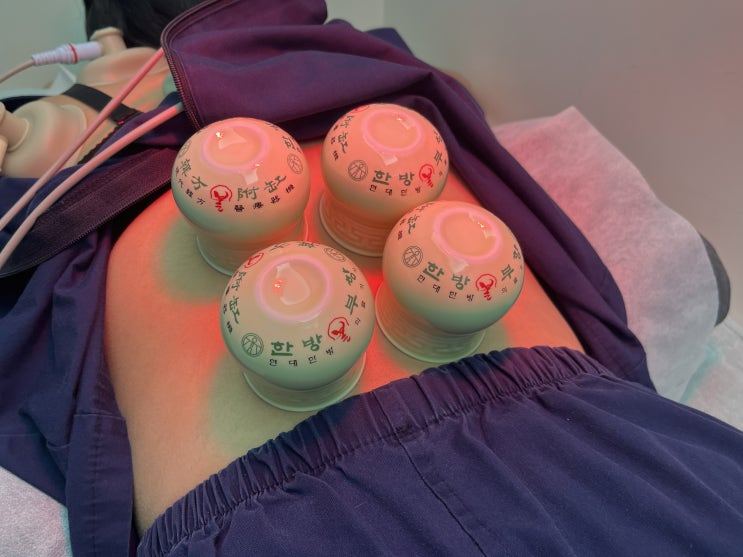 복부에 여러 개의 부항을 놓은 치료 모습