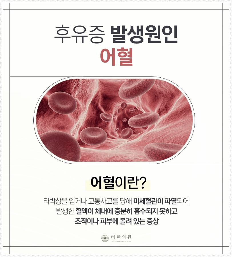 후유증 발생원인 어혈을 설명하는 카드뉴스